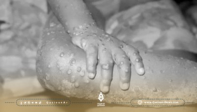 وباء جدري القرود يجتاح العالم