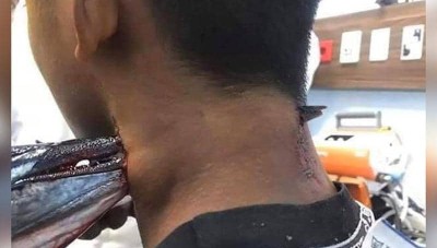 سمكة الإبرة قفزت من المياه.. واخترقت رقبة محمد