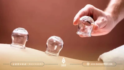 "البديل الأرخص" انتشار العلاج بالحجامة في سوريا